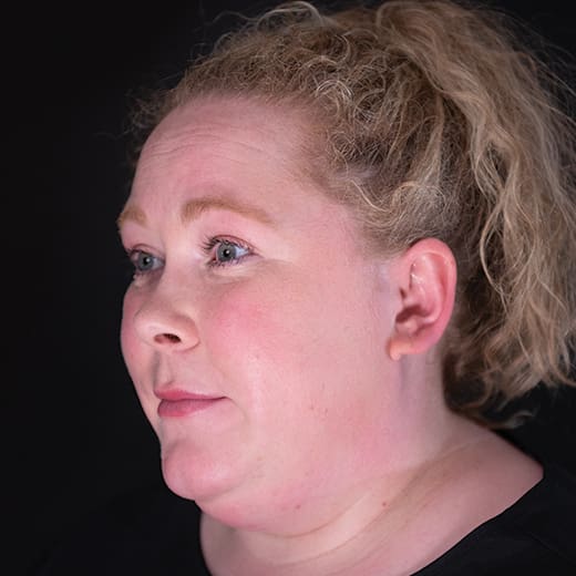 Before wrinkle-relaxing injections, addressing forehead lines.