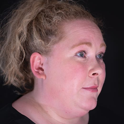 Before wrinkle-relaxing injections, addressing forehead lines.