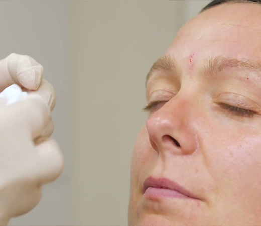 Close-up of practitioner preparing to administer a facial injection while the patient rests with eyes closed in a clinical setting.