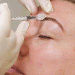 Close-up of practitioner administering an eyebrow injection with a syringe while wearing gloves in a clinical setting.