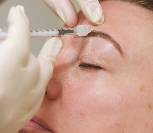 Close-up of practitioner administering an eyebrow injection with a syringe while wearing gloves in a clinical setting.