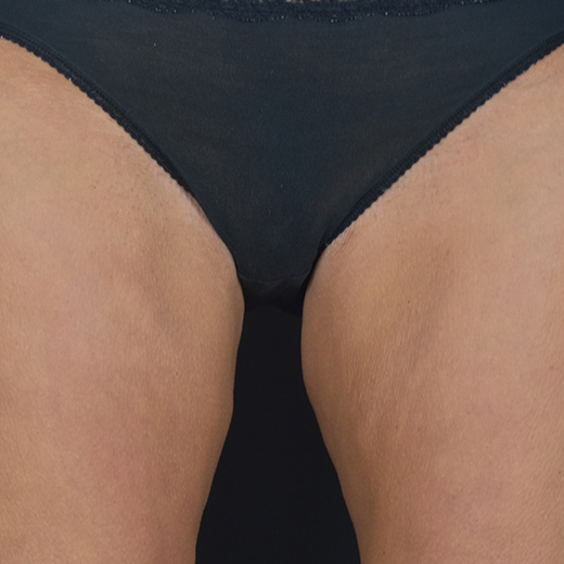 After treatment, addressing inner & outter thighs and bum.