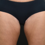 Before treatment, addressing inner & outter thighs and bum.
