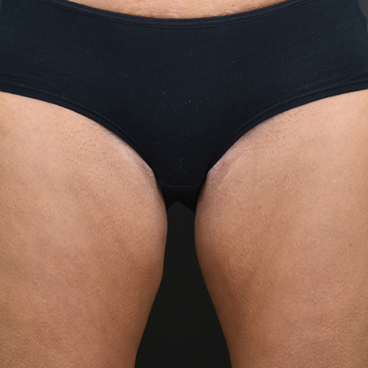 Before treatment, addressing inner & outter thighs and bum.