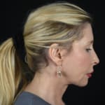 After a deep plane face and neck lift.