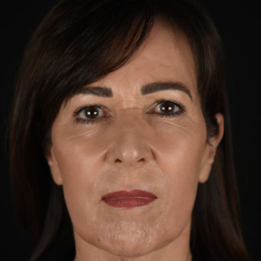 After full facelift.