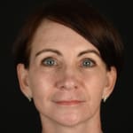 After full facelift and deep plane face and neck lift with Halo laser treatment