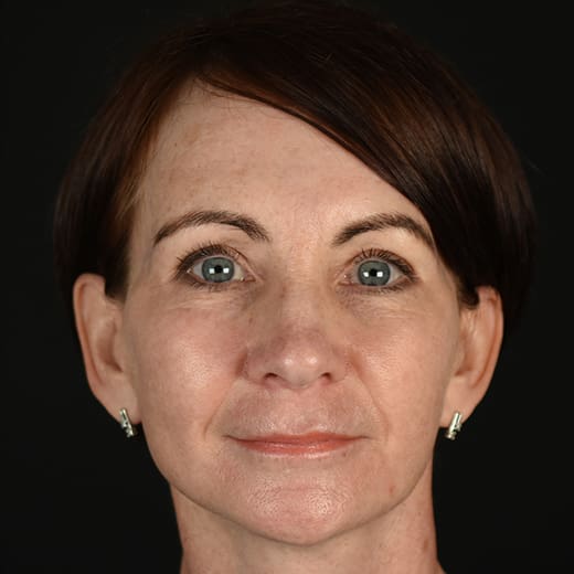 After full facelift and deep plane face and neck lift with Halo laser treatment