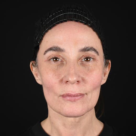 After result of a full facelift with deep plane face and neck lift and jowl lift, addressing sagging neck, sagging jawline, and jowls