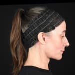 After results of a full facelift with deep plane face and neck lift and jowl lift, addressing sagging neck, sagging jawline, and jowls