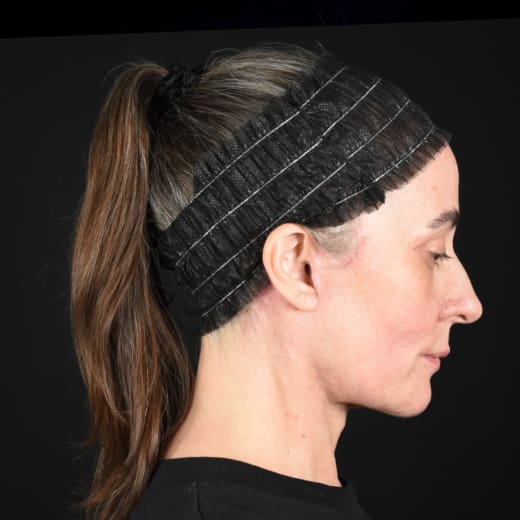 After results of a full facelift with deep plane face and neck lift and jowl lift, addressing sagging neck, sagging jawline, and jowls