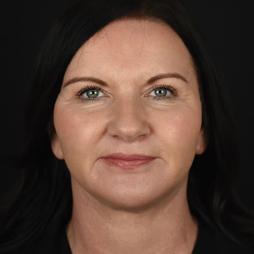 After a full facelift, deep plane face and neck lift, liposuction under the chin, and upper eyelid surgery.