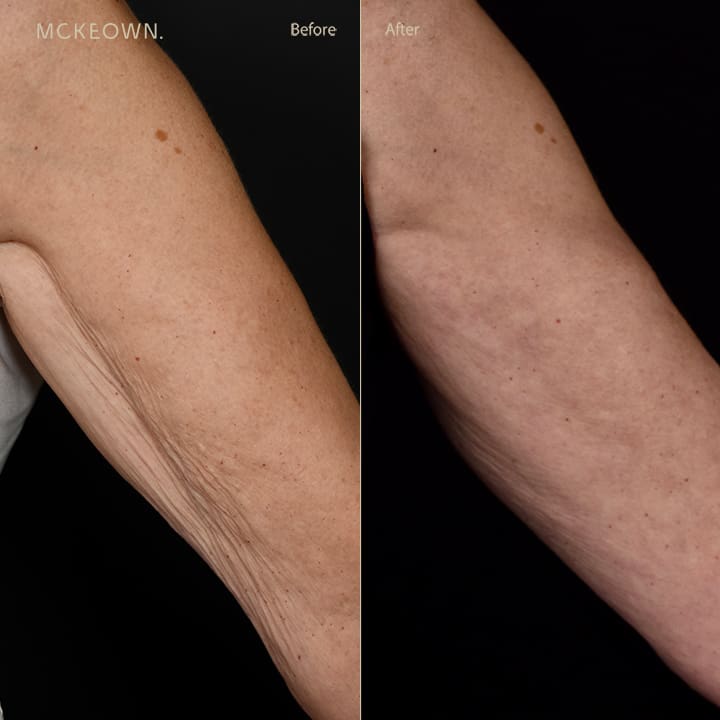 Before and after results of BBL SkinTyte treatment, addressing sagging arms (bingo wings)