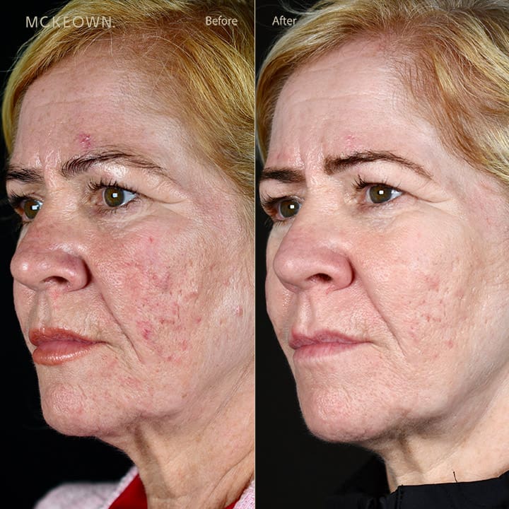Before and after results of BBL treatment, addressing skin texture and acne scarring.