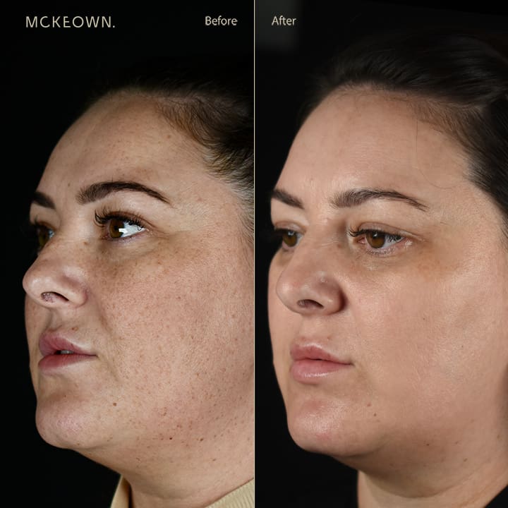 Before and after results of BBL treatment, addressing sun damage, freckles, and lower cheek wrinkles