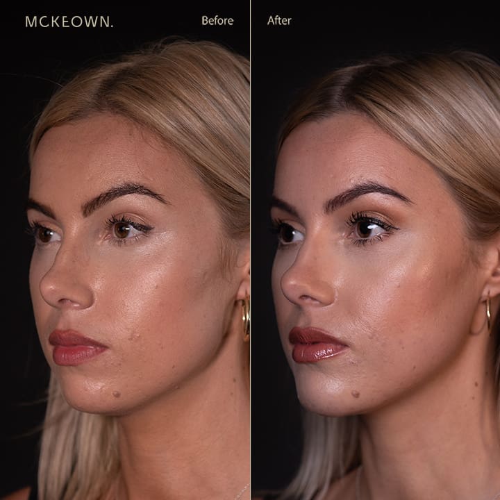 Before and after results of chin and jaw filler with chin augmentation, addressing a deficient jawline