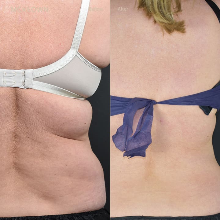 Before and after results of CoolSculpting, addressing back fat and bra fat