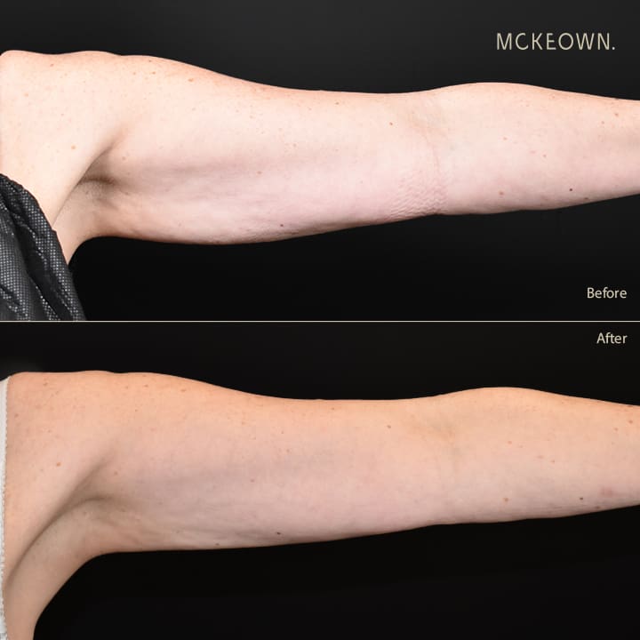 Before and after results of CoolSculpting, addressing sagging arms (bingo wings)