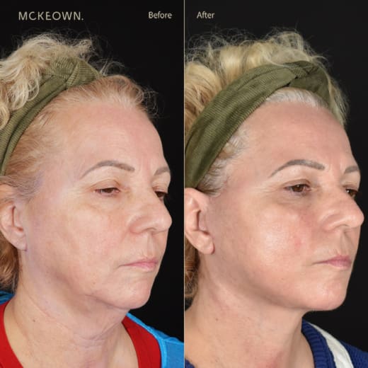 Before and after results of a deep plane face and neck lift with jowl lift, addressing jowls, sagging neck, and sagging jawline