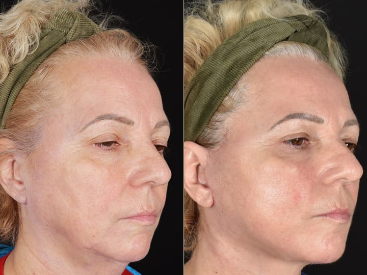 Before and after results of a deep plane face and neck lift with jowl lift, addressing jowls, sagging neck, and sagging jawline