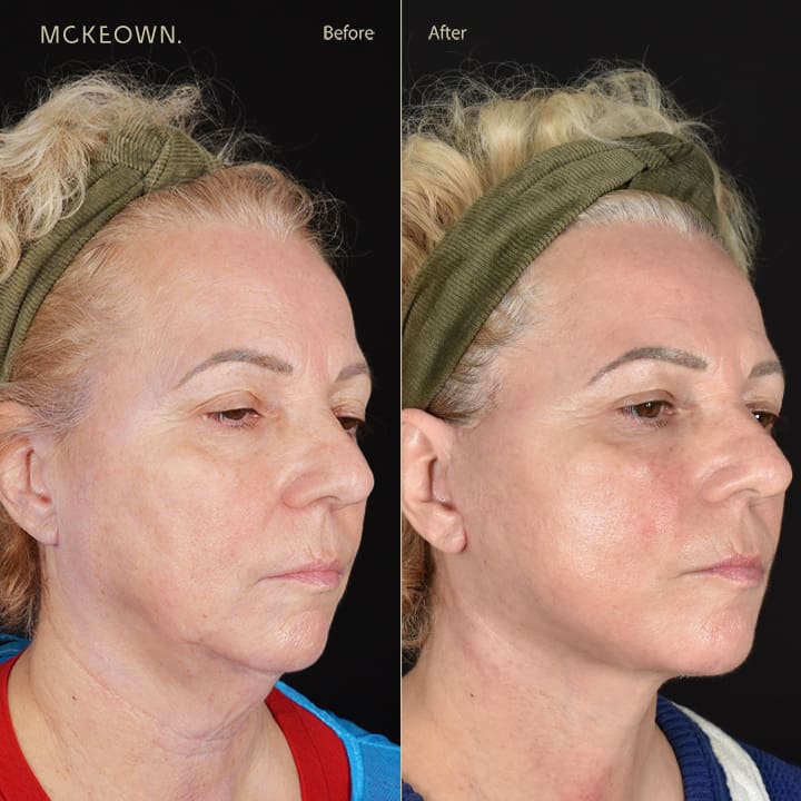 Before and after results of a deep plane face and neck lift with jowl lift, addressing jowls, sagging neck, and sagging jawline