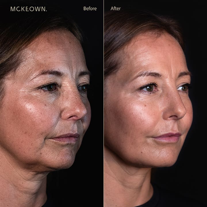 Before and after results of facial fillers including lip augmentation, addressing lip lines, marionette lines, thin lips, reduced lip volume, and lipstick/smokers' lines