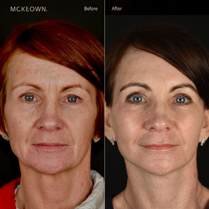 Before And After Full Facelift Deep Plane Face And Neck Lift Halo Laser Freckles