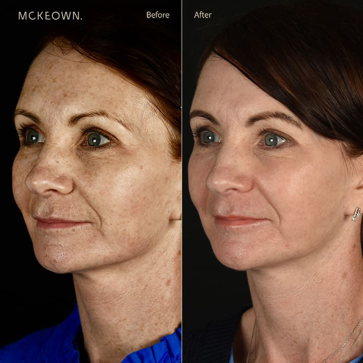 Before and after results of a full facelift with deep plane face and neck lift and Halo laser, addressing freckles