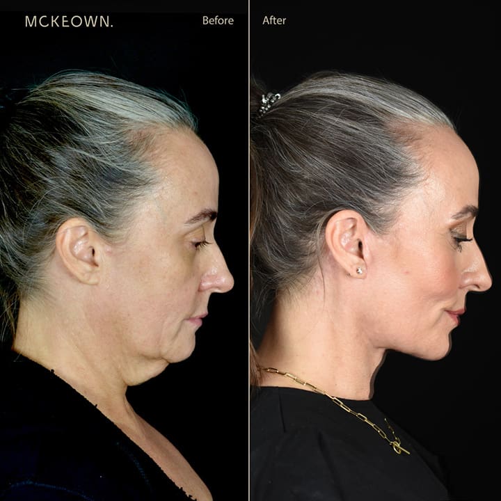 Before and after results of a full facelift with deep plane face and neck lift and jowl lift, addressing sagging neck, sagging jawline, and jowls
