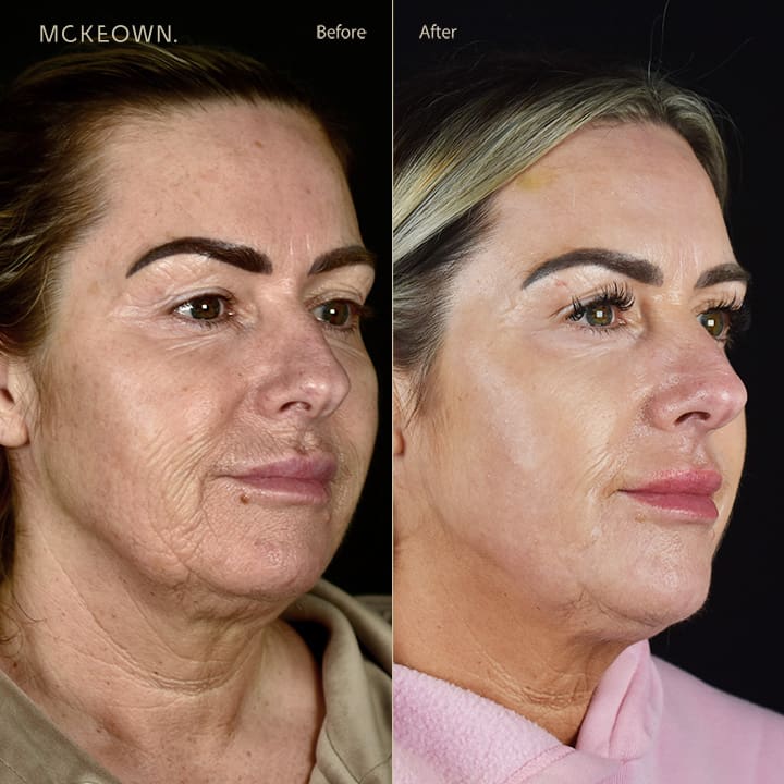 Before and after results of full laser resurfacing, addressing fine lines, wrinkles, sun damage, and uneven skin tone