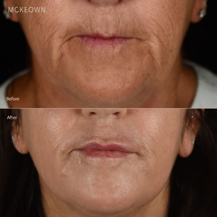 Before and after results of full laser resurfacing, addressing lines and wrinkles, lip lines, and lipstick lines