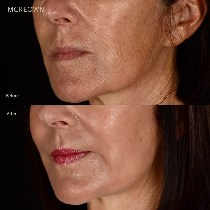 Before and after results of full laser resurfacing, addressing lines, wrinkles, and sun damage
