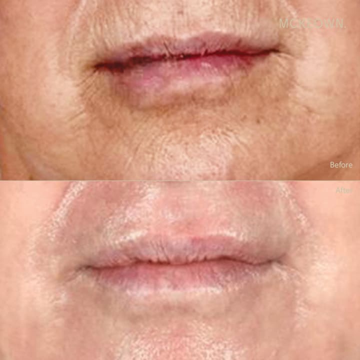 Before and after results of full laser resurfacing to the lips, addressing lipstick lines / smokers' lines