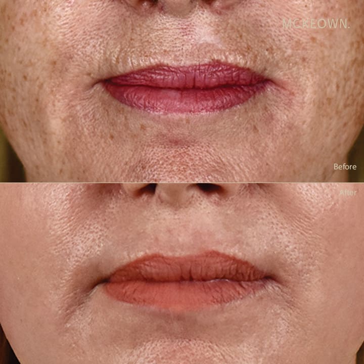 Before and after results of full laser resurfacing treatment, addressing lipstick lines / smokers' lines