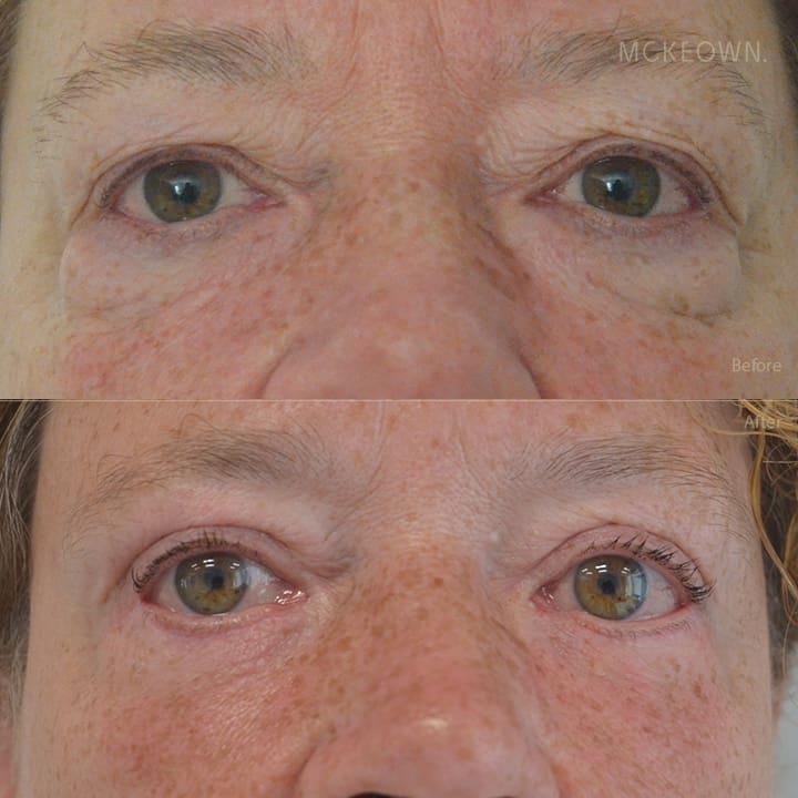 Before and after results of lower blepharoplasty, addressing lower eye bags