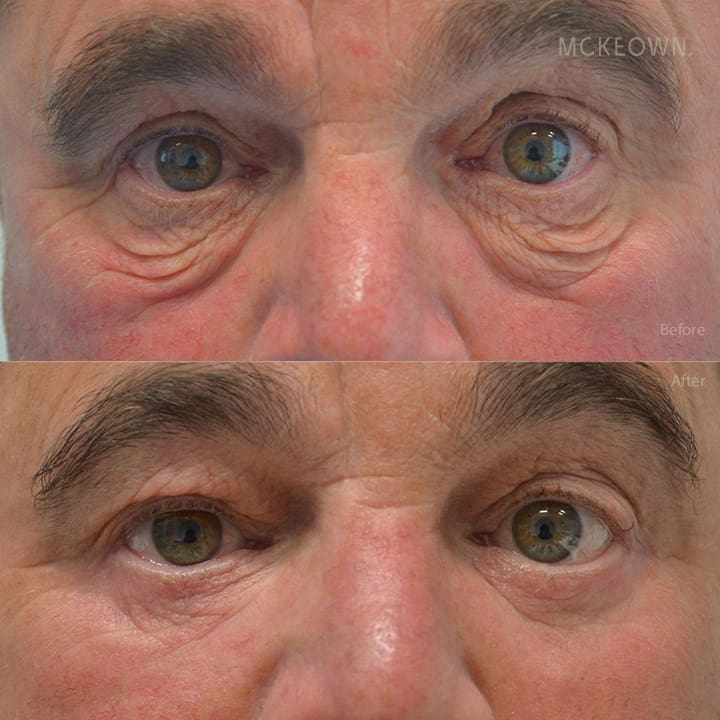 Before and after results of lower blepharoplasty, addressing under-eye bags