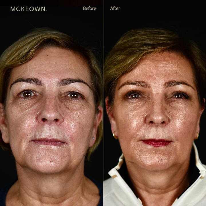 Before and after results of a non-surgical facelift with BBL treatment