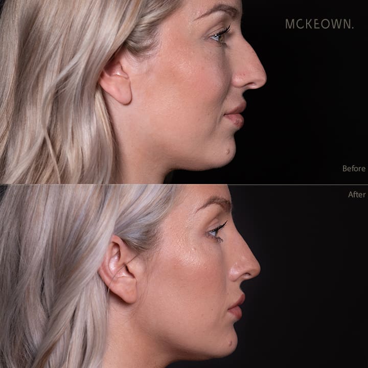 Before and after results of non-surgical rhinoplasty with chin and jaw filler, addressing a prominent nose and achieving chin balance