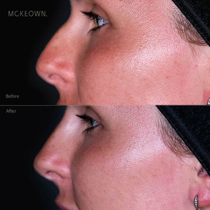Before and after results of non-surgical rhinoplasty / nose contouring, addressing a nose bump