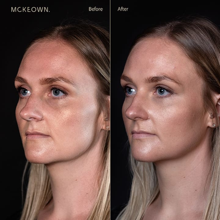 Before and after results of tear trough filler, addressing dark circles under the eyes