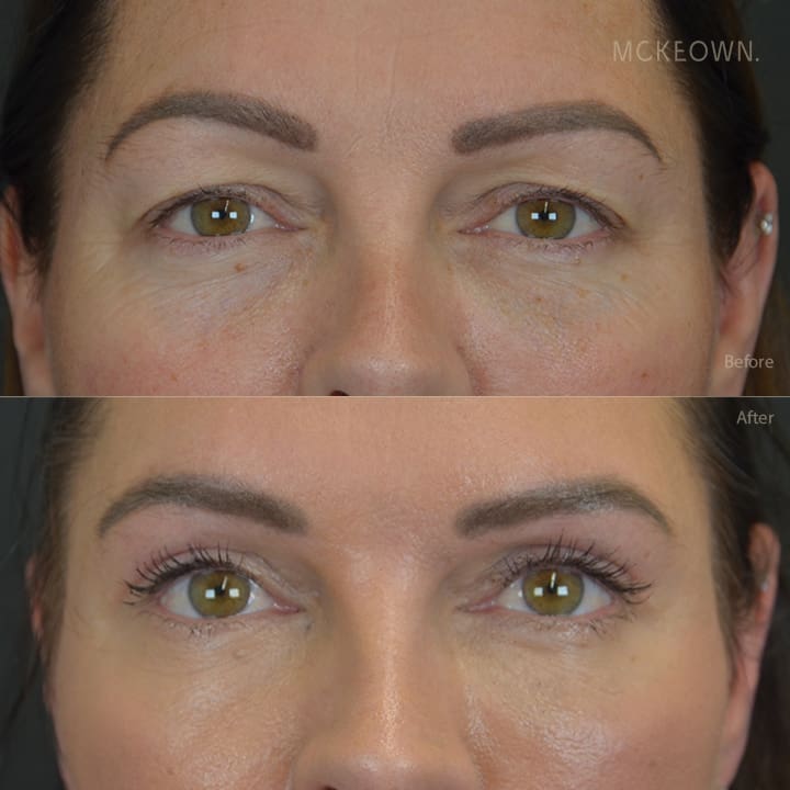 Before and after results of upper blepharoplasty (upper eyelid surgery), addressing heavy upper eyelids