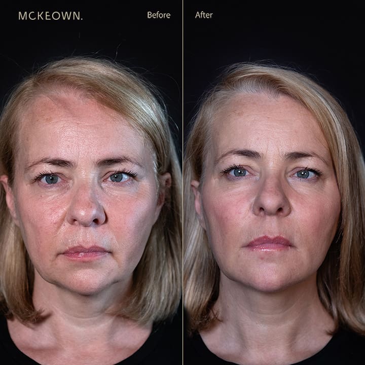 Before and after results of a volumetric facelift with cheek, chin, and jawline filler, addressing jowls