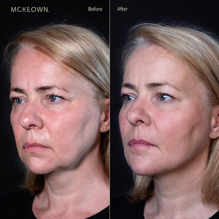 Before and after results of a volumetric facelift with cheek, chin, and jawline filler, addressing jowls