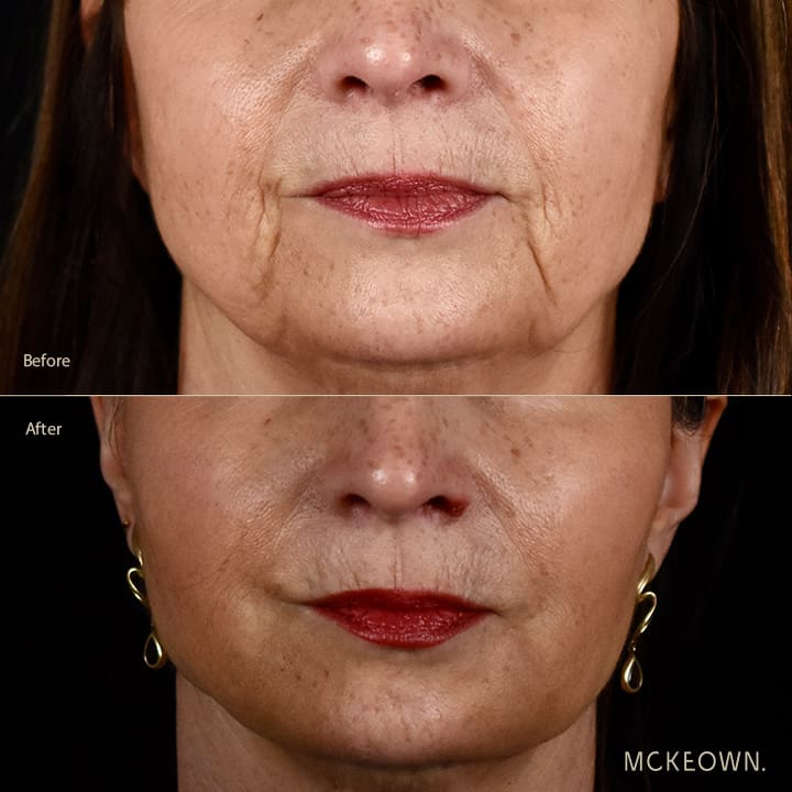 Before and after results of a volumetric facelift with cheek filler and treatment for marionette lines