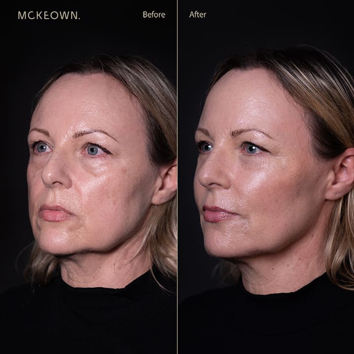 Before and after results of a volumetric facelift with jowl lift, chin augmentation, and tear trough filler, addressing sagging jawline, jowls, under-eye bags, and dark circles