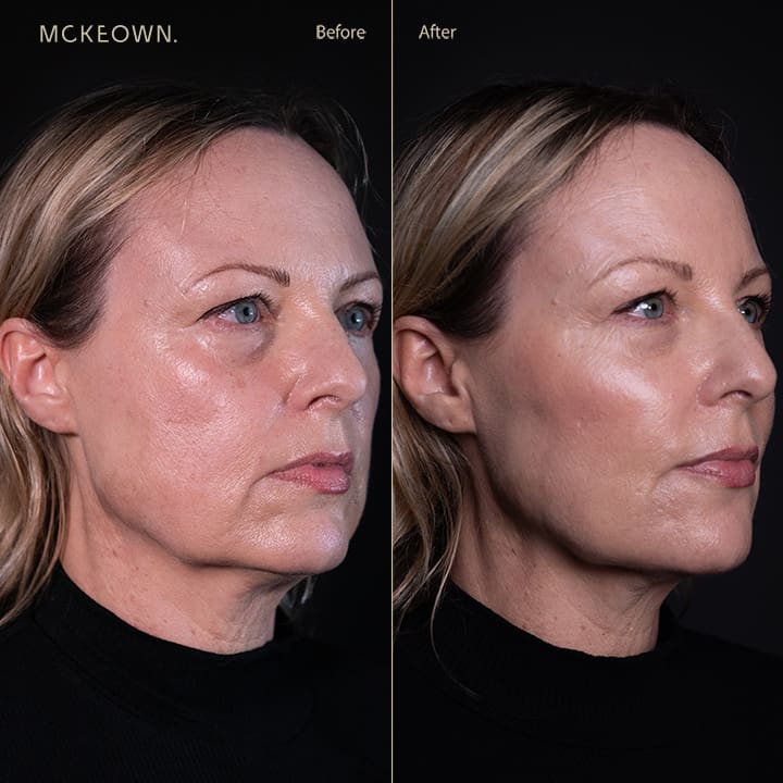 Before and after results of a volumetric facelift with jowl lift, chin augmentation, and tear trough filler, addressing sagging jawline, jowls, under-eye bags, and dark circles