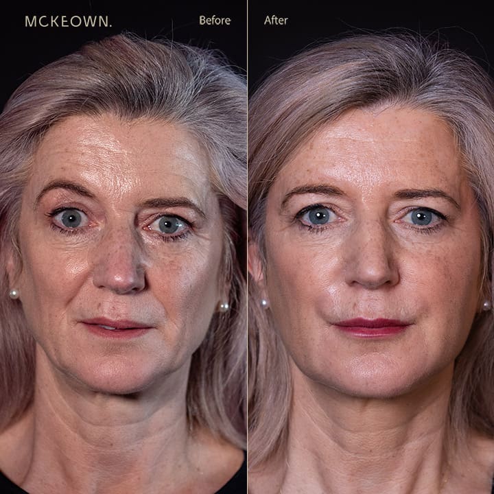 Before and after results of a volumetric facelift with jowl lift and chin, jaw, and cheek filler, addressing sagging cheeks and sagging jawline