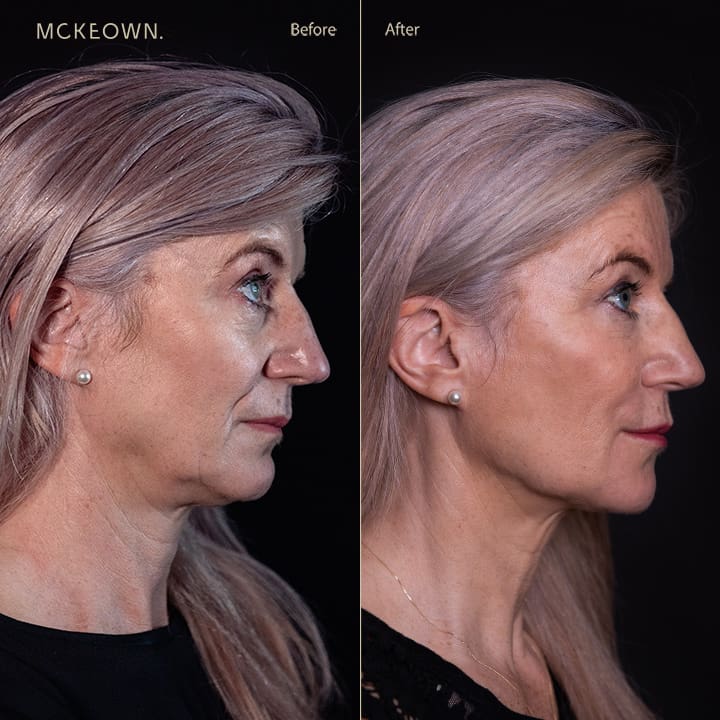 Before and after results of a volumetric facelift with jowl lift and chin, jaw, and cheek filler, addressing sagging cheeks and sagging jawline