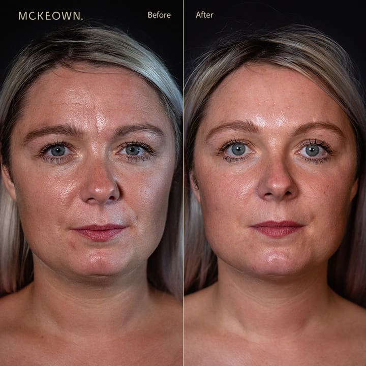 Before and after results of wrinkle-relaxing injections and fillers, addressing frown lines