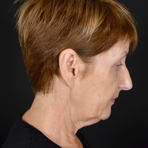 Before a deep plane face and neck lift, and eyelid surgery.